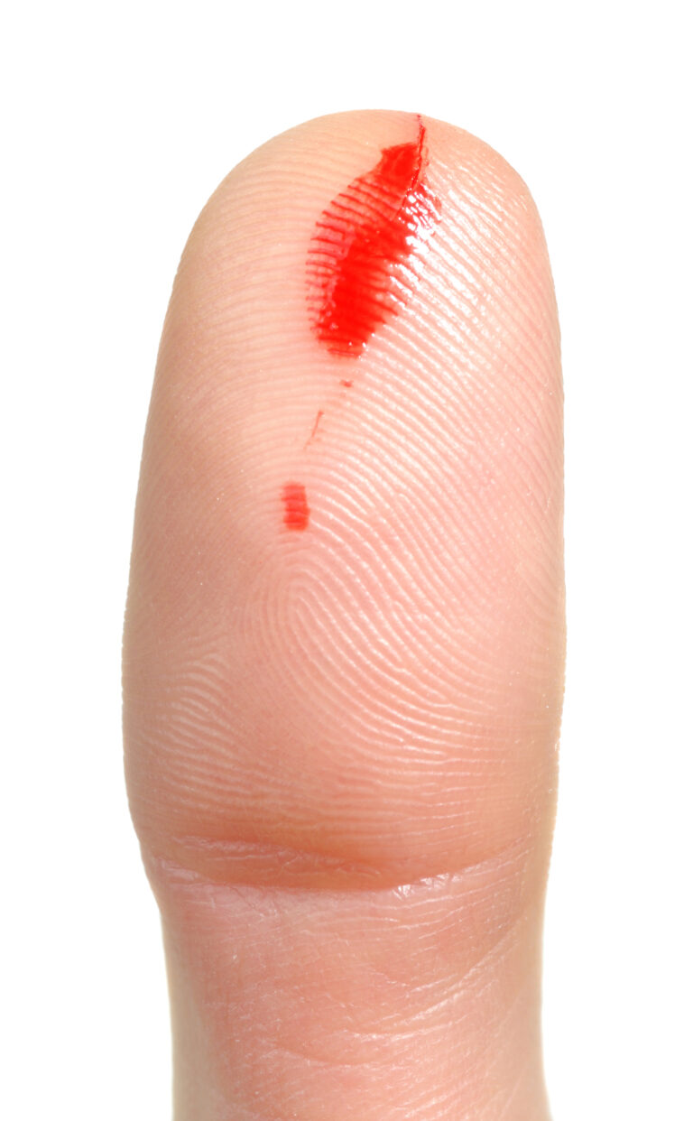 Can Your Fingers Bleed From Playing Guitar?